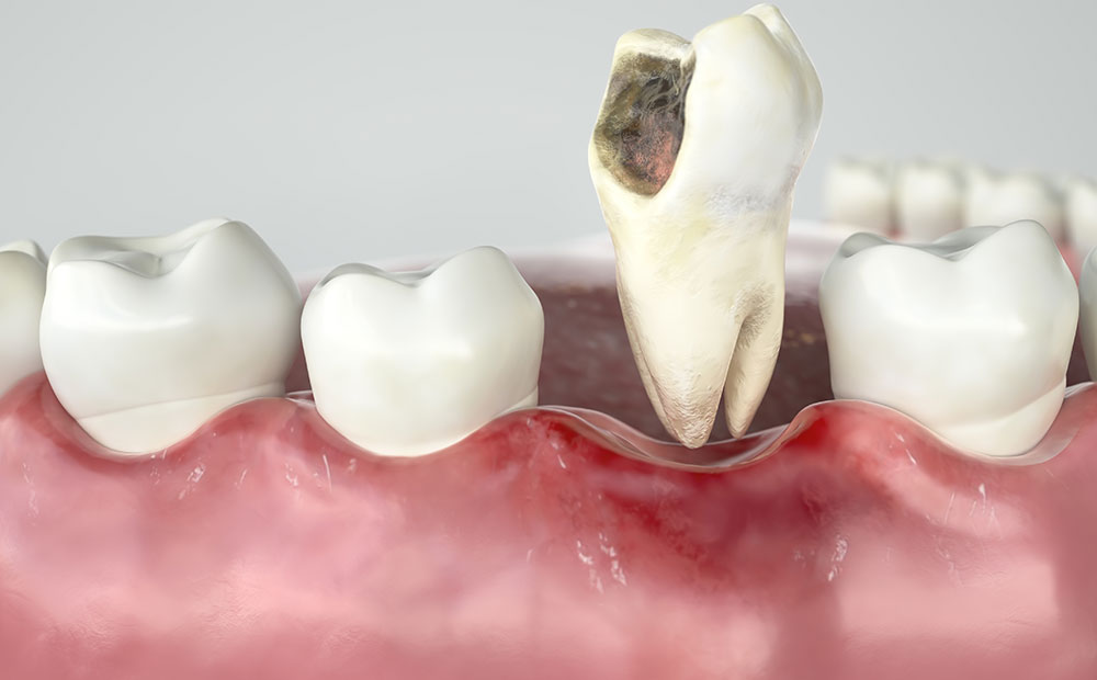 インビザライン